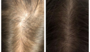 Мезотерапия волос головы (фото 005)