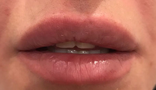 Коррекция формы губ 