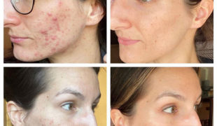 Лечение кожи лица у косметолога Киев